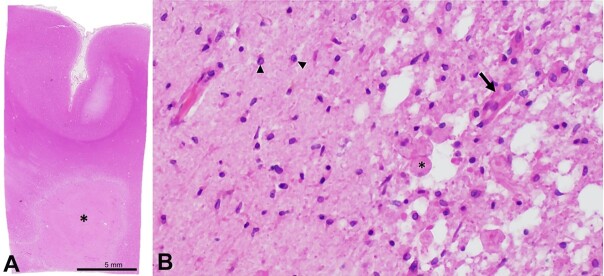 Radiologic-pathologic autopsy correlation of an internal watershed infarct, a case report.