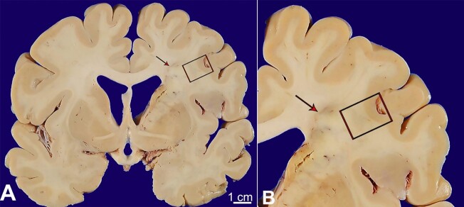Radiologic-pathologic autopsy correlation of an internal watershed infarct, a case report.