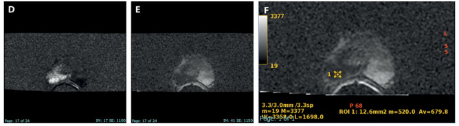 Granulomatous prostatitis: mimicking locally advanced prostate adenocarcinoma.
