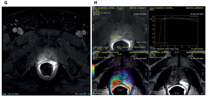 Granulomatous prostatitis: mimicking locally advanced prostate adenocarcinoma.