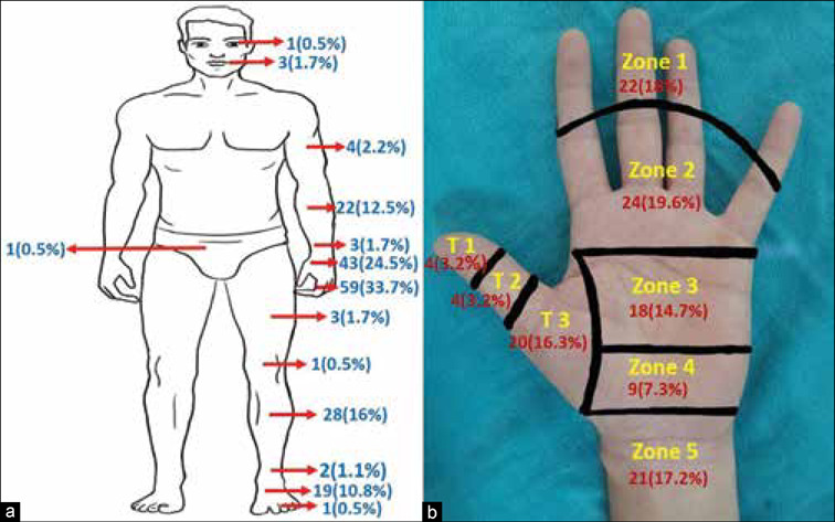 A retrospective observational study of injury patterns associated with powered circular saw in subjects presenting to the emergency department of a tertiary care hospital.