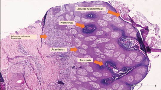 Neurosyphilis in a young man having HIV infection, blurring of vision and skin rash.