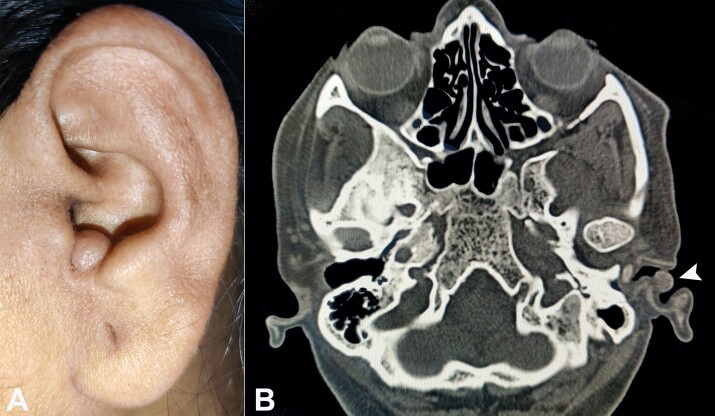 Dermal cylindroma of the external auditory canal.