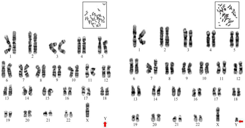 A Rare Case of 45,X/46,X,del(Y)(q12→qter) Mosaicism in An Infertile Male with Y Chromosome Microdeletion.