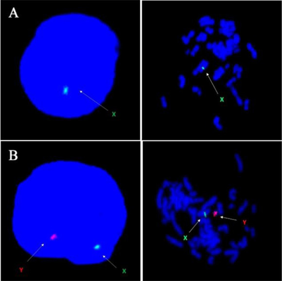 A Rare Case of 45,X/46,X,del(Y)(q12→qter) Mosaicism in An Infertile Male with Y Chromosome Microdeletion.
