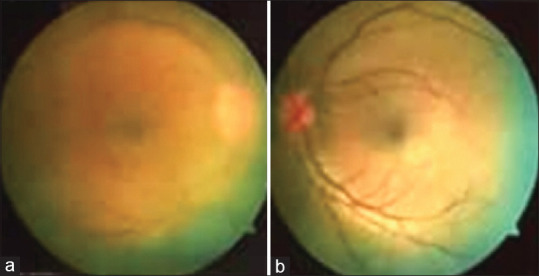 Neurosyphilis in a young man having HIV infection, blurring of vision and skin rash.