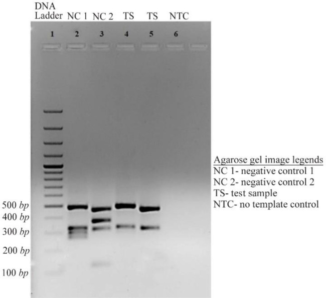 A Rare Case of 45,X/46,X,del(Y)(q12→qter) Mosaicism in An Infertile Male with Y Chromosome Microdeletion.
