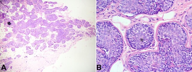 Dermal cylindroma of the external auditory canal.