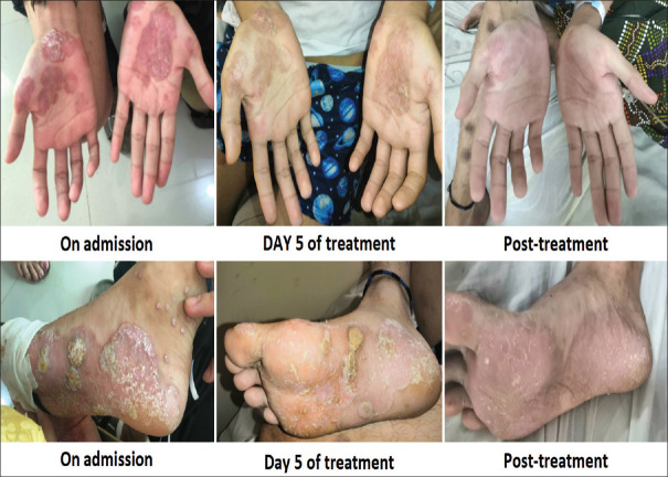 Neurosyphilis in a young man having HIV infection, blurring of vision and skin rash.