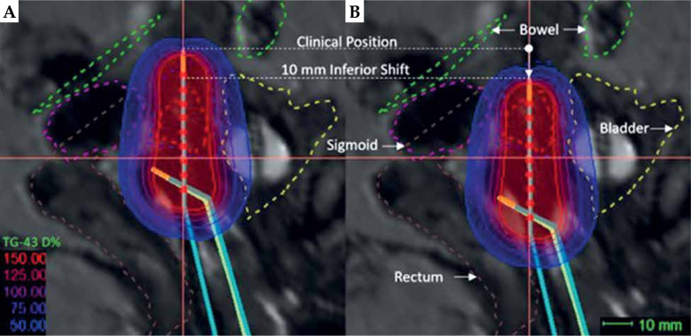 Dosimetric impact of applicator displacement on three-dimensional image-guided high-dose-rate brachytherapy treatments for cervical cancer.