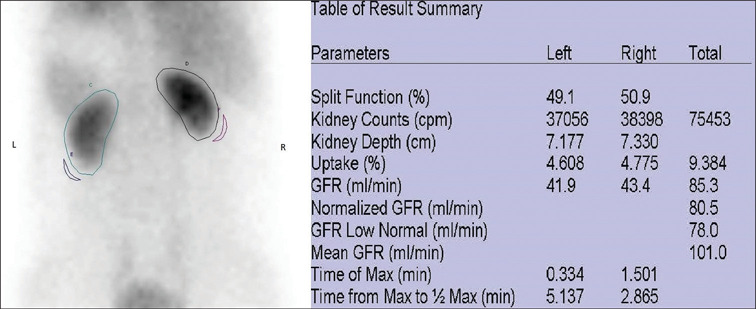 Predictive Value of Camera-based Donor Glomerular Filtration Rate Estimation on the Immediate Renal Allograft Outcome Following Live-related Renal Transplant: A Single-center Retrospective Study.