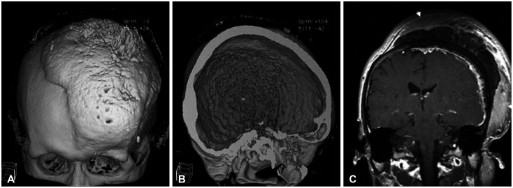 Massive Hyperostotic Meningioma En Plaque Mimicking Fibrous Dysplasia.