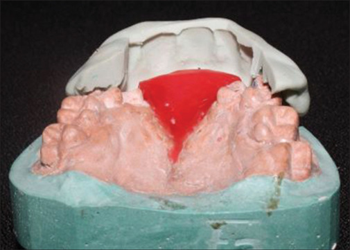 Rehabilitation of a Patient with Cleft Palate Using a Hollow Lightweight Fixed Prosthesis.