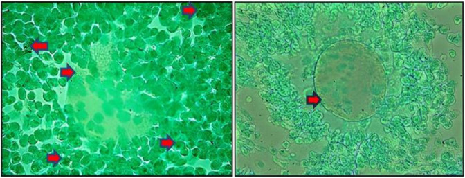 The Impact of Endometriosis on Intracellular Calcium Levels, Cyclic Dependent Kinase 1 (Cdk1) Expression, and Cyclin B Expression in Post-Ovulation Oocytes of Mice Model.