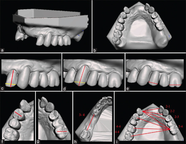 Accuracy of models of partially edentulous arches obtained by three-dimensional printing: An <i>in vitro</i> study.
