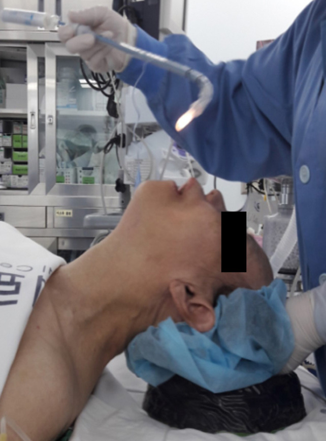 The sniffing position facilitated easier light wand guided endotracheal intubation compared with the neutral position with chin-lift.
