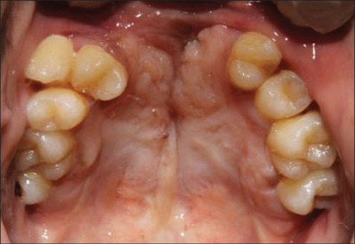 Rehabilitation of a Patient with Cleft Palate Using a Hollow Lightweight Fixed Prosthesis.