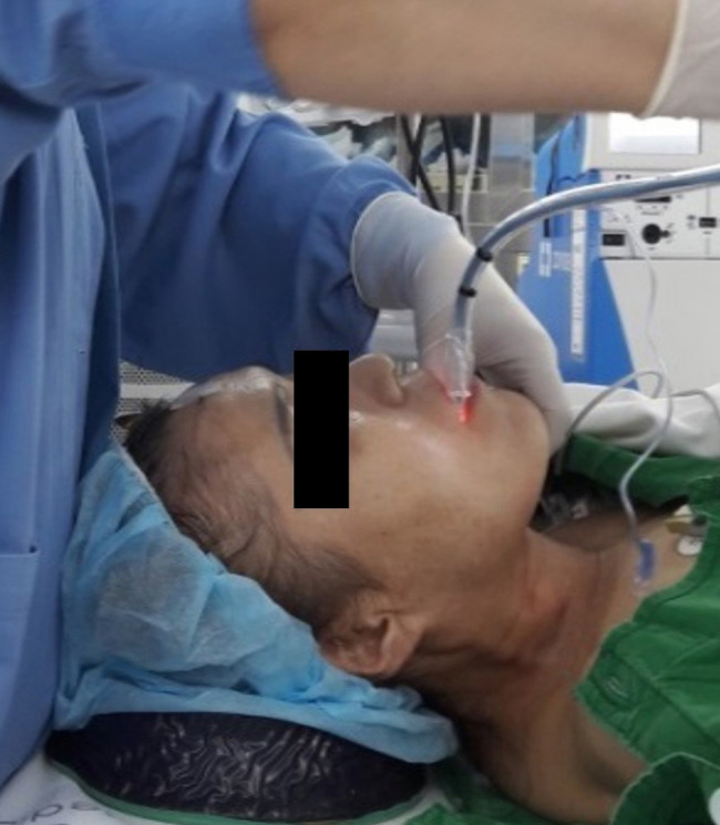 The sniffing position facilitated easier light wand guided endotracheal intubation compared with the neutral position with chin-lift.