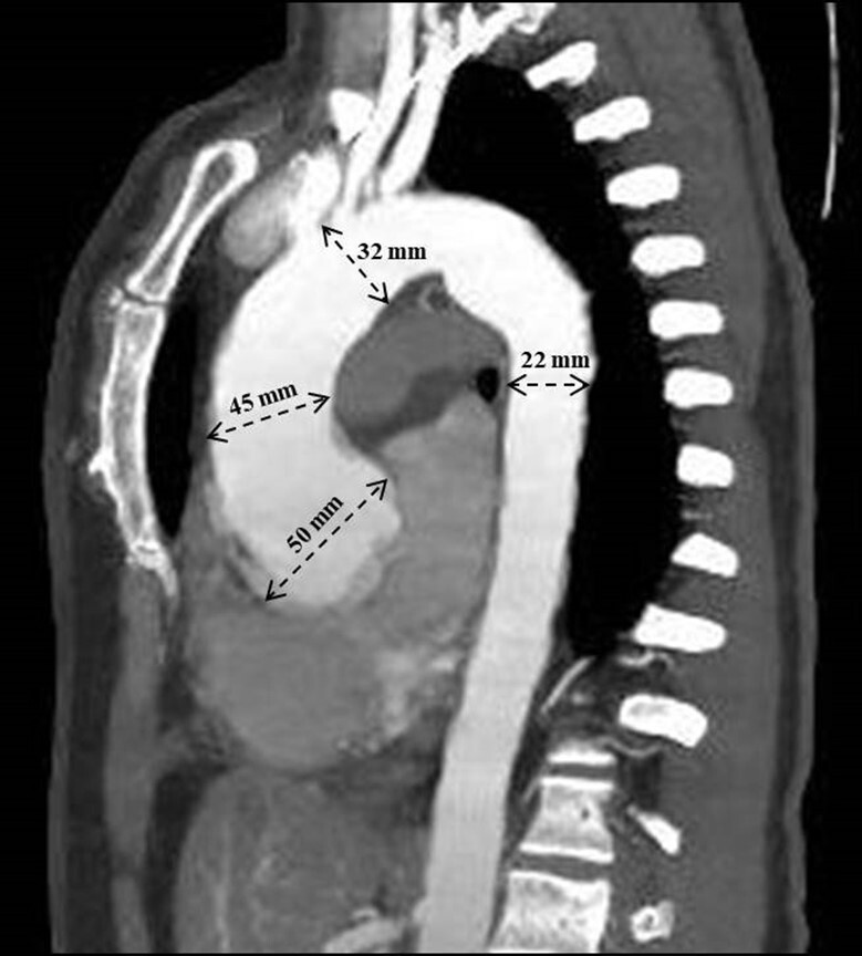Rare association between giant-cell aortitis and giant-cell aortic valvulitis.