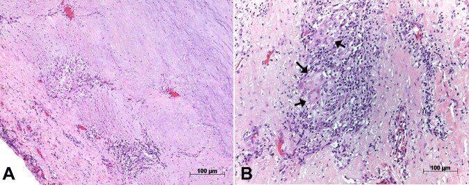 Rare association between giant-cell aortitis and giant-cell aortic valvulitis.