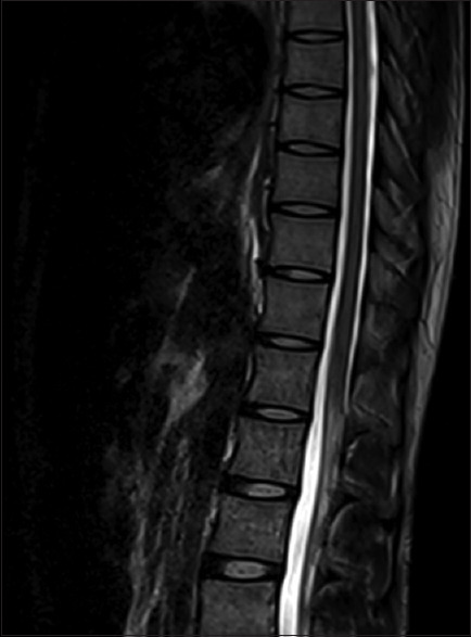 A rare presentation of acute transverse myelitis.