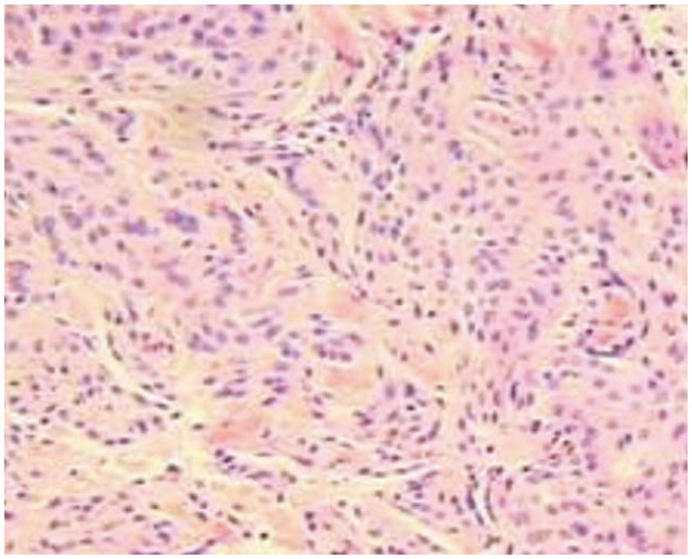 Massive Hyperostotic Meningioma En Plaque Mimicking Fibrous Dysplasia.