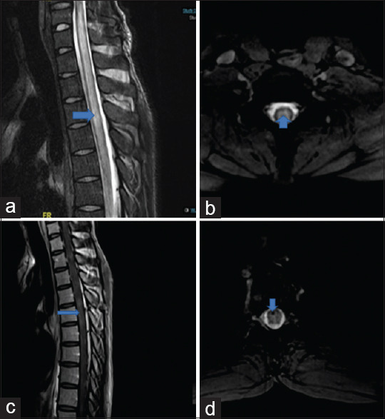 A rare presentation of acute transverse myelitis.