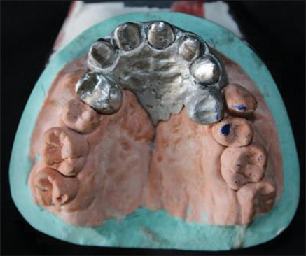 Rehabilitation of a Patient with Cleft Palate Using a Hollow Lightweight Fixed Prosthesis.