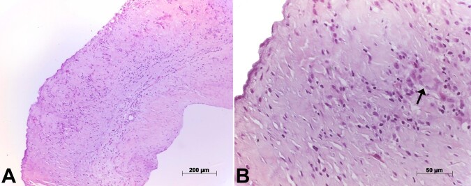 Rare association between giant-cell aortitis and giant-cell aortic valvulitis.