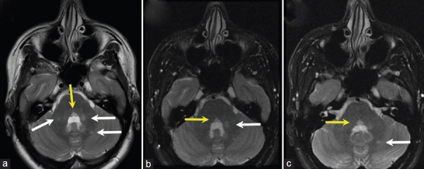 Bilateral horizontal gaze palsy as an initial presentation of a clinically isolated syndrome: A case report.