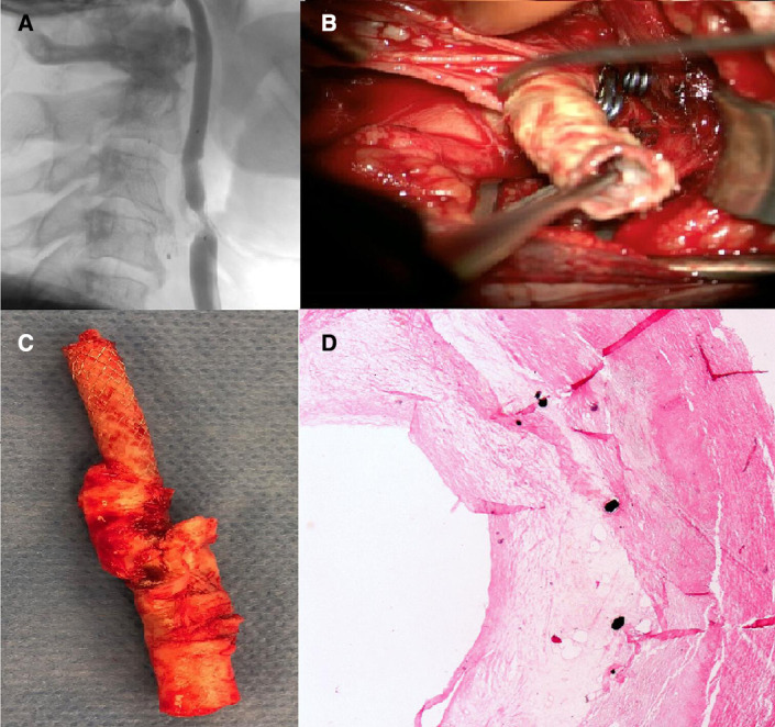 Comparison of carotid endarterectomy and repeated carotid angioplasty and stenting for in-stent restenosis (CERCAS trial): a randomised study.