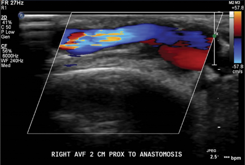 Venous Free Flap with Interposition Bypass Graft for Arteriovenous Fistula Preservation: A Case Report.