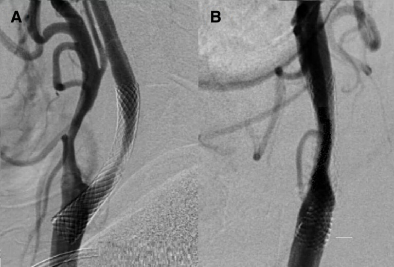 Comparison of carotid endarterectomy and repeated carotid angioplasty and stenting for in-stent restenosis (CERCAS trial): a randomised study.