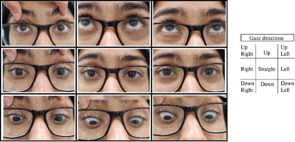 Bilateral horizontal gaze palsy as an initial presentation of a clinically isolated syndrome: A case report.