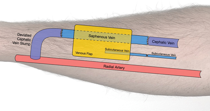 Venous Free Flap with Interposition Bypass Graft for Arteriovenous Fistula Preservation: A Case Report.