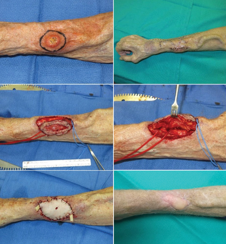 Venous Free Flap with Interposition Bypass Graft for Arteriovenous Fistula Preservation: A Case Report.