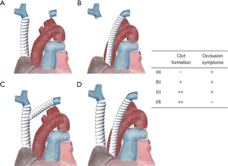 Perioperative management and postoperative outcomes of locally advanced thymic epithelial tumors: a narrative review.