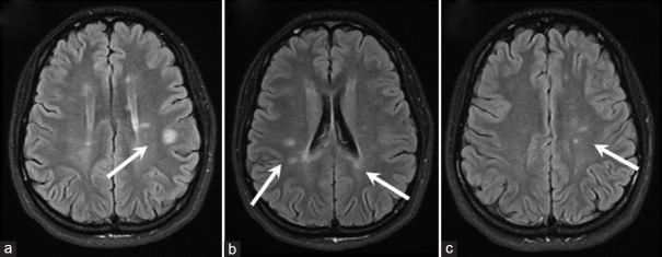 Bilateral horizontal gaze palsy as an initial presentation of a clinically isolated syndrome: A case report.