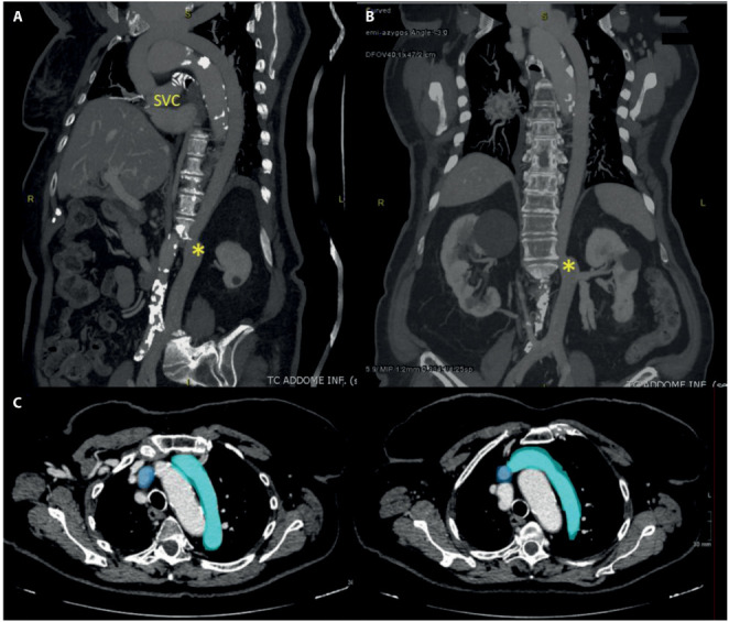 A remarkable case report of an interrupted inferior vena cava with hemiazygos and transhepatic continuation.