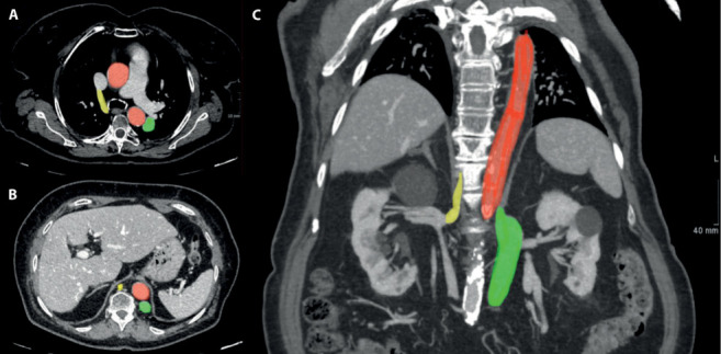 A remarkable case report of an interrupted inferior vena cava with hemiazygos and transhepatic continuation.