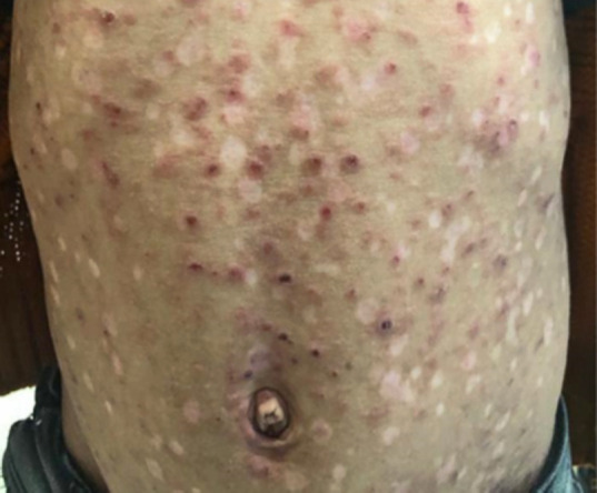 Pityriasis Lichenoides et Varioliformis Acuta Case with Enterobiasis, Giardiasis, and Helicobacter pylori Infection.