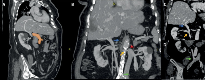 A remarkable case report of an interrupted inferior vena cava with hemiazygos and transhepatic continuation.