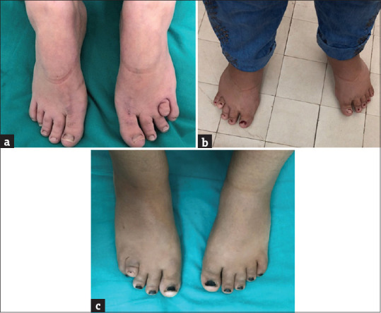 The Use of Fluorescence <i>In situ</i> Hybridisation in the Diagnosis of Hidden Mosaicism in Egyptian Patients with Turner Syndrome.