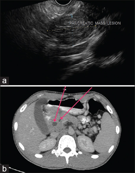 Synchronous pancreatic and scrotal tuberculosis: Double jeopardy.