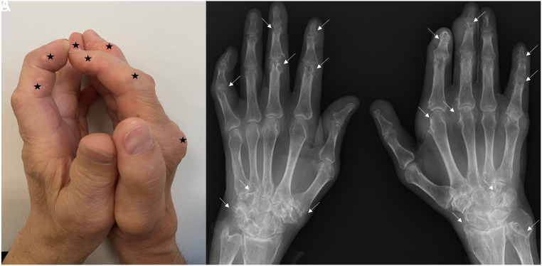 Positive Prayer Sign in Tophaceous Gout.