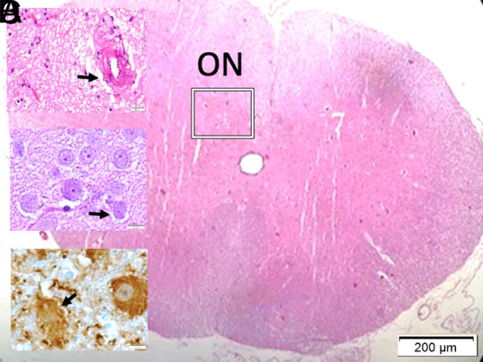 Changes in the Urethral Artery After Experimental Subarachnoid Hemorrhage-Induced Injury of the Pudendal Ganglion and Onuf's Nucleus Junction.