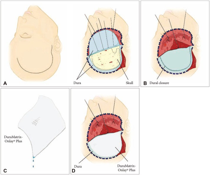 A Case Series of DuraMatrix-Onlay<sup>®</sup> Plus in Cranial Surgery Is Associated With a Low Complication Profile.