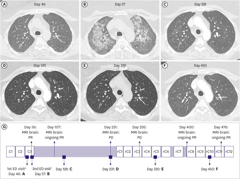 Successful Trastuzumab-Deruxtecan Rechallenge After Interstitial Lung Disease: A Case Report.