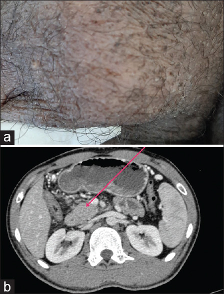Synchronous pancreatic and scrotal tuberculosis: Double jeopardy.