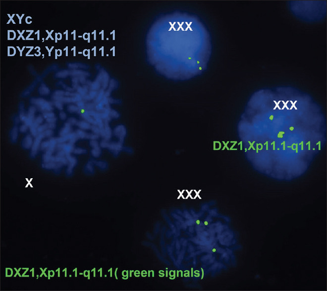 The Use of Fluorescence <i>In situ</i> Hybridisation in the Diagnosis of Hidden Mosaicism in Egyptian Patients with Turner Syndrome.